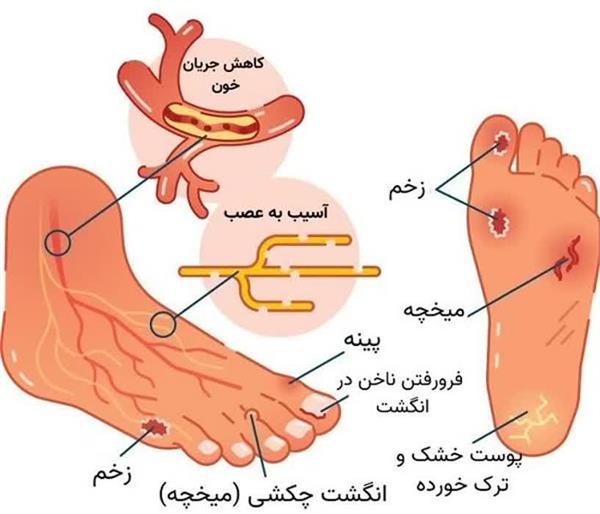 علائم زخم پای دیابتی